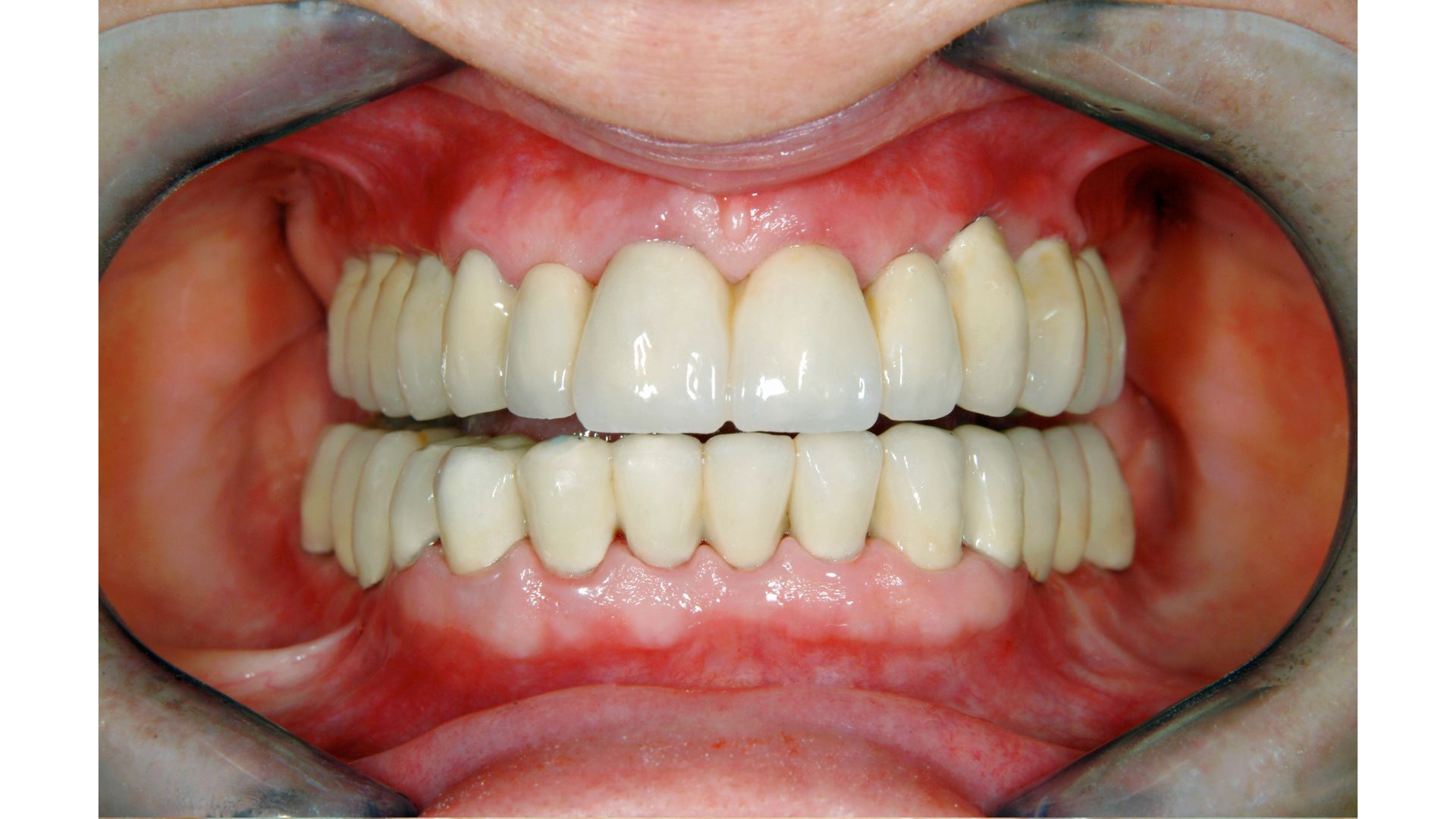 günstiger Zahnersatz mit Kronen und Implantaten