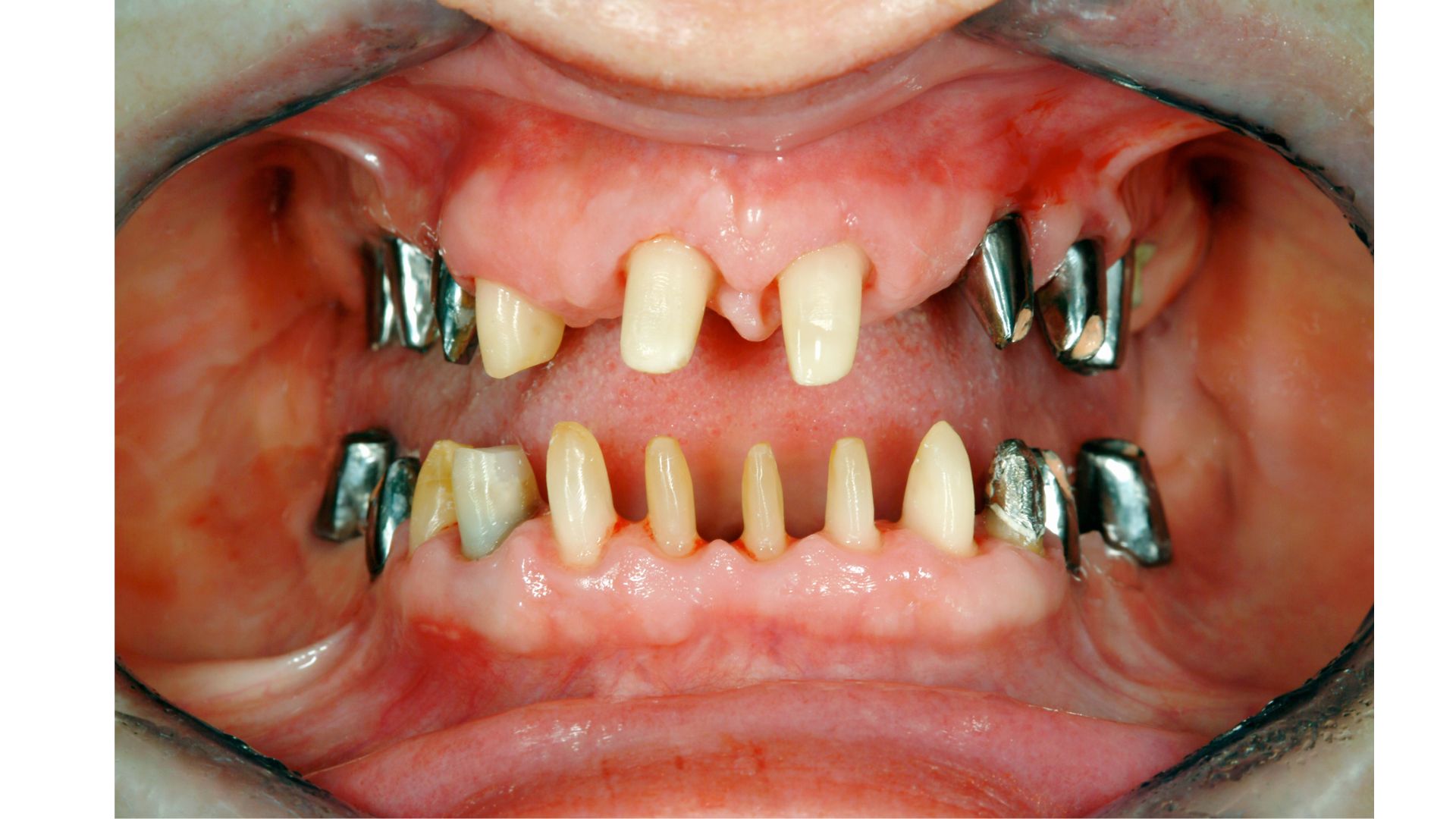 Zähne vor Behandlung mit Kronen