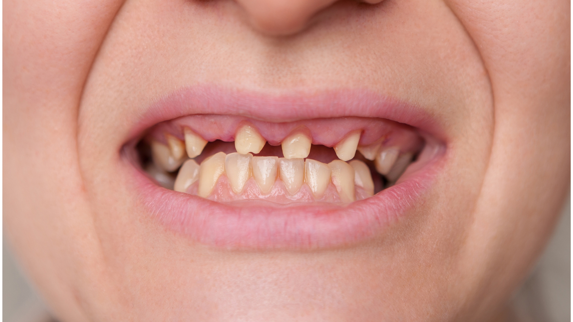 Fehlende Zähne vor der Zahnbehandlung