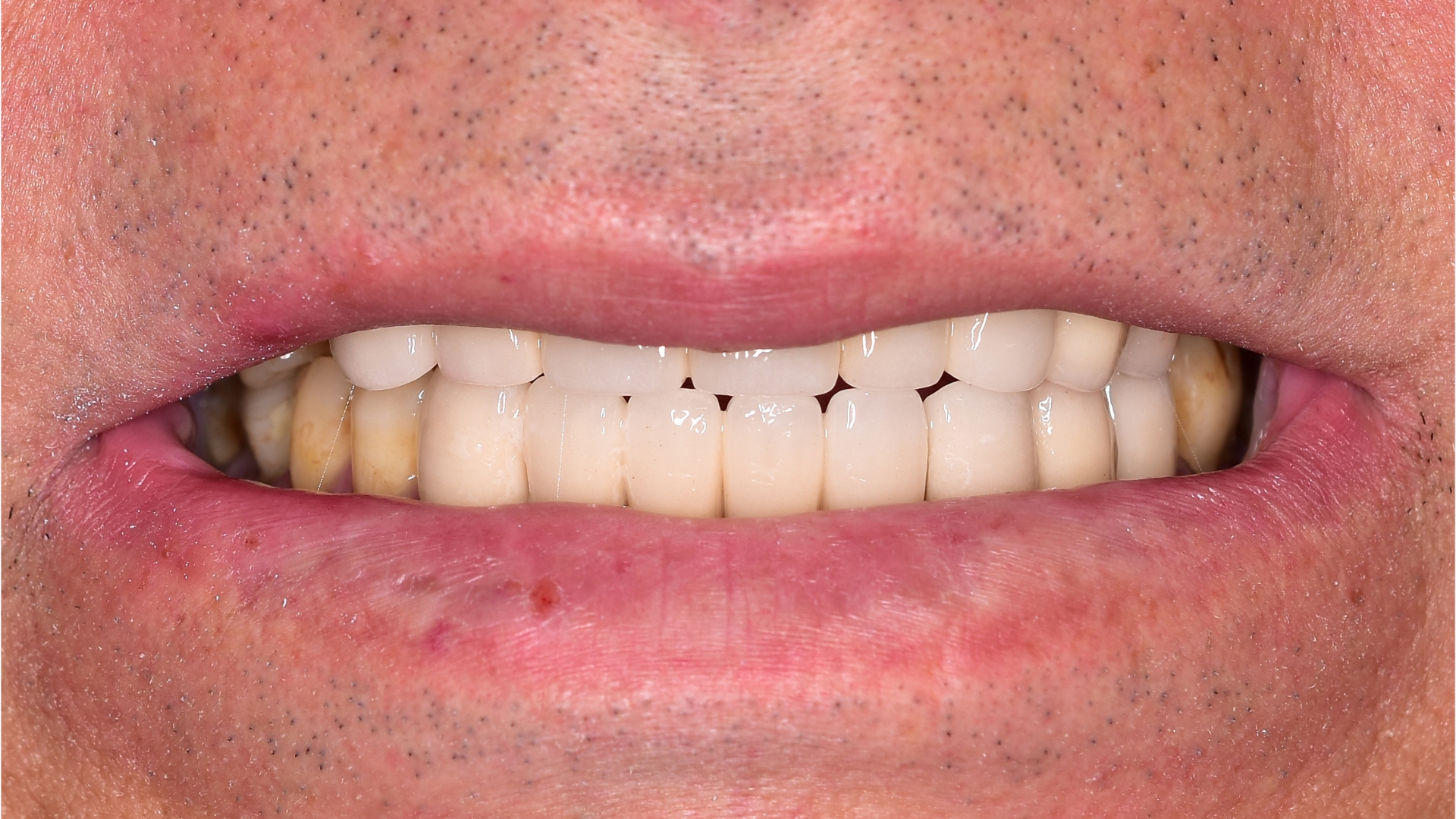 Zähne mit günstigem Zahnersatz Implantat