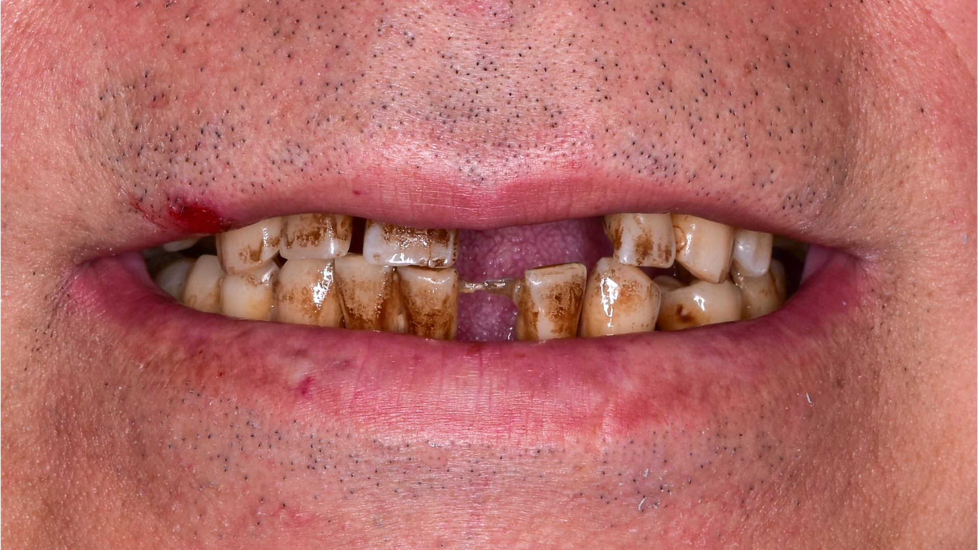 vorher Fehlende schwarze und gelbe Zähne